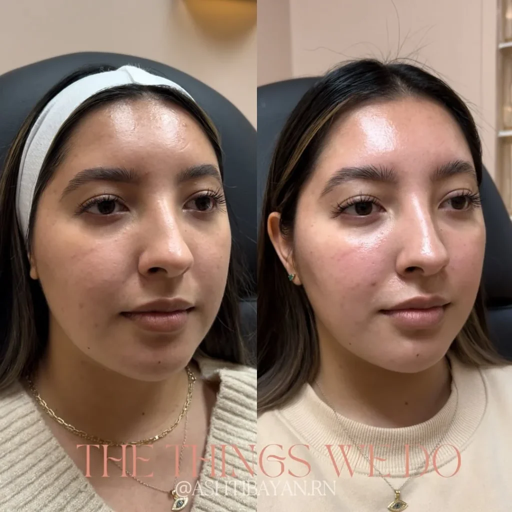 Skinvive Before and After: Real Patient Results and Benefits 2 Kylee, Age 27: Skinvive Before and After results