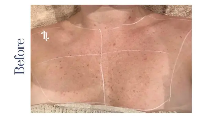 IPL Before and After: Your Ultimate Guide to Radiant Skin 2 Jane image of IPL Before and After
