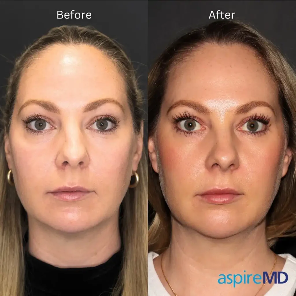 Skinvive Before and After: Real Patient Results and Benefits 3 Amber, Age 33 Detailed Before and After Results Skinvive