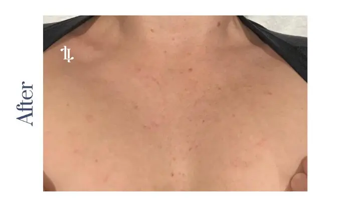 IPL Before and After: Your Ultimate Guide to Radiant Skin 3 Jane after IPL