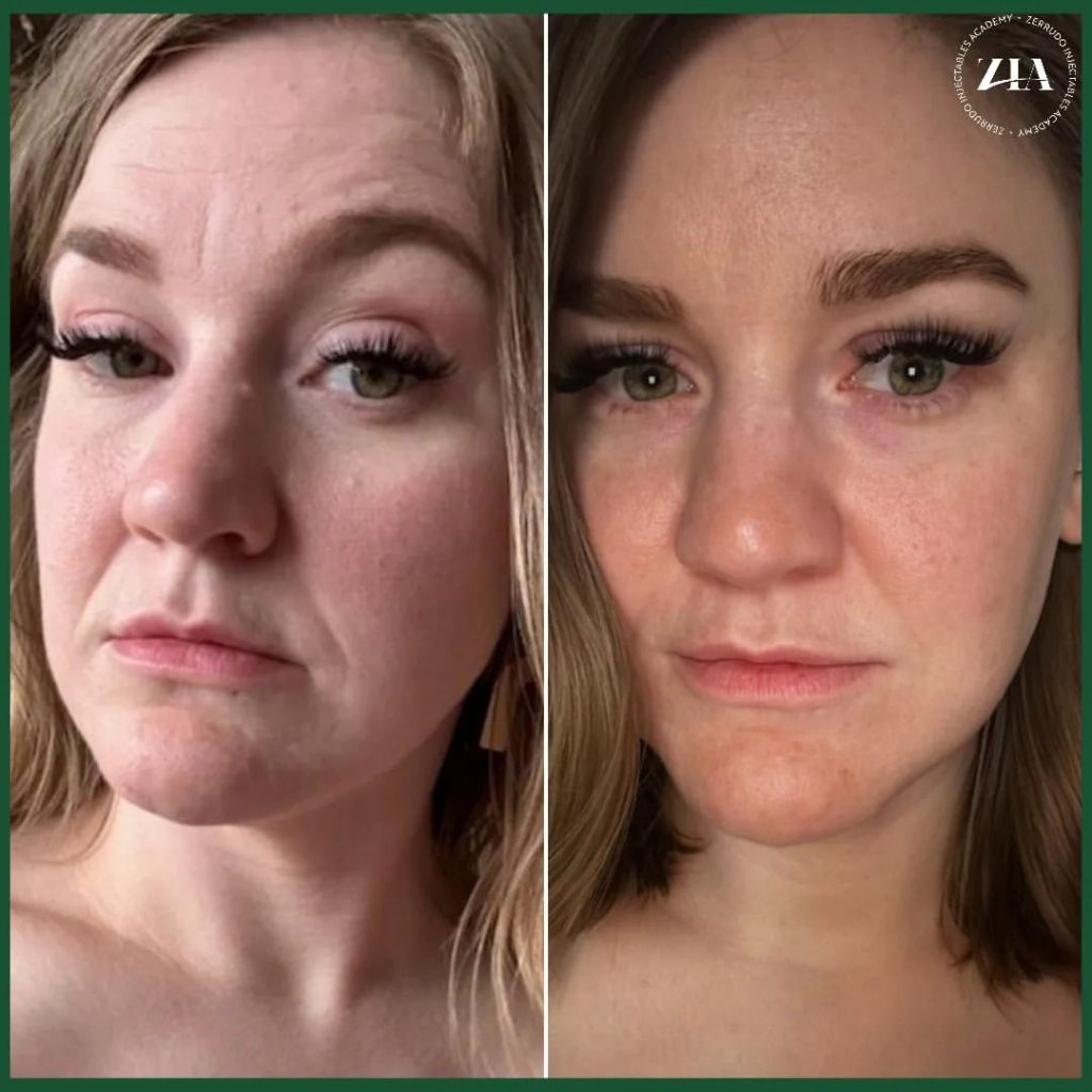 Skinvive Before and After: Real Patient Results and Benefits 4 Christy, Age 57:Detailed Before and After Results Skinvive