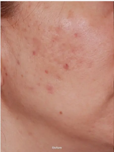 IPL Before and After: Your Ultimate Guide to Radiant Skin 4 Clara before IPL