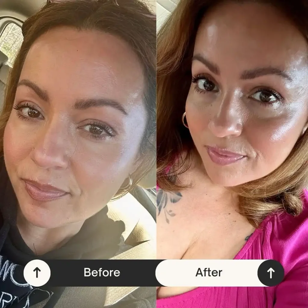 Skinvive Before and After: Real Patient Results and Benefits 5 Angelica, Age 35: Detailed Before and After Results Skinvive
