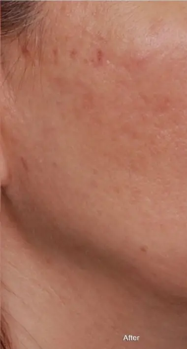 IPL Before and After: Your Ultimate Guide to Radiant Skin 5 Clara after IPL