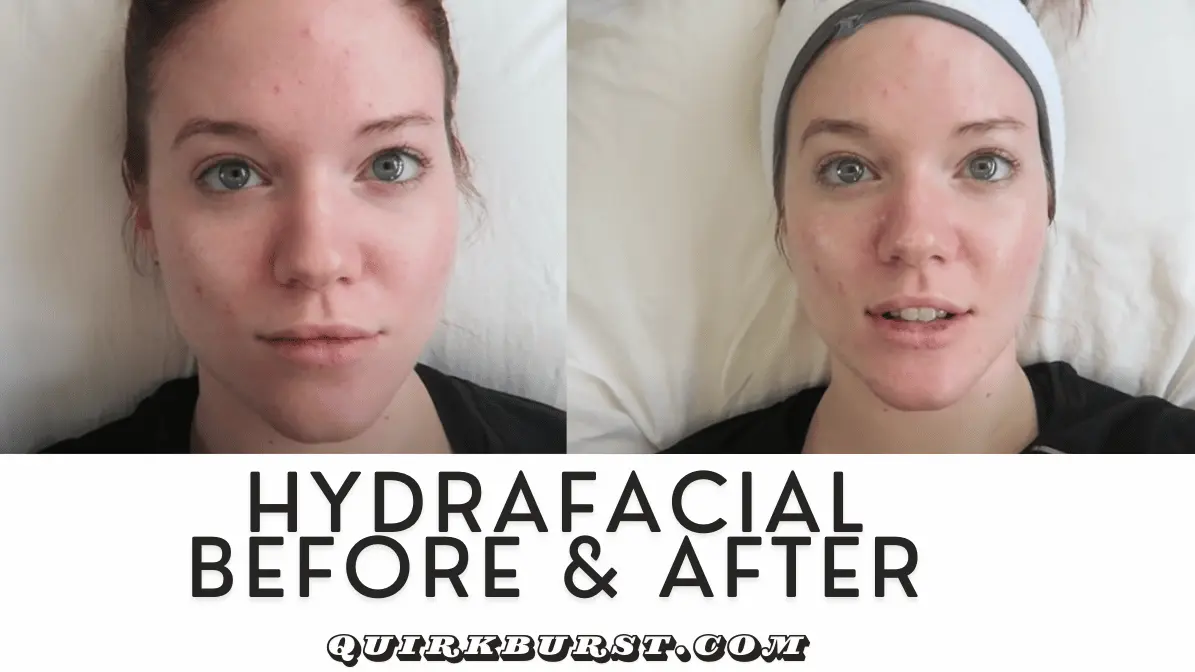HydraFacial Before and After: The Remarkable Transformation 1 HydraFacial Before and After