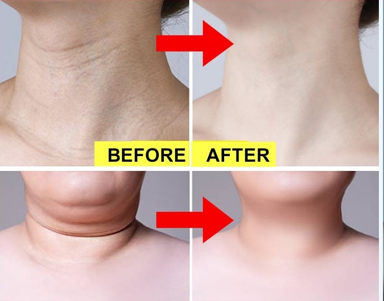 Neck Tightening Solutions: Fix Sagging Skin and Wrinkles Fast 8 neck tightening feature image