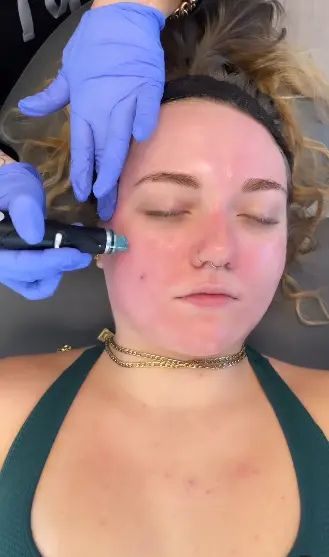 How Often should You Get a HydraFacial 3 How Often should You Get a HydraFacial