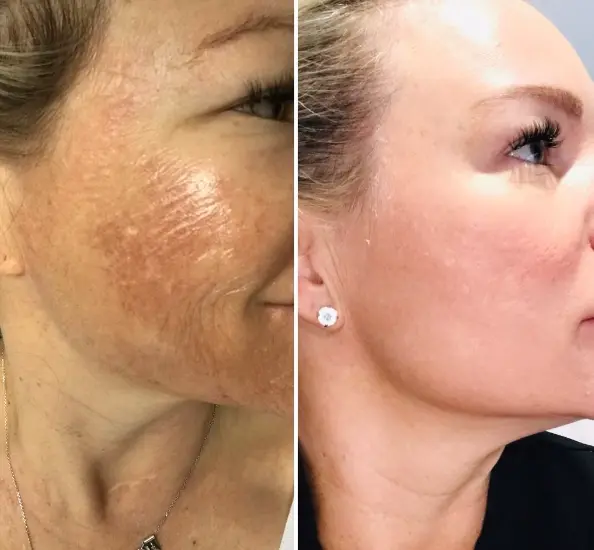 HydraFacial Steps: The Complete Guide to Glowing, Rejuvenated Skin 3 HydraFacial Steps