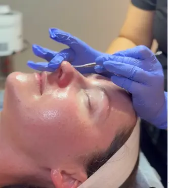 HydraFacial Steps: The Complete Guide to Glowing, Rejuvenated Skin 4 HydraFacial Steps