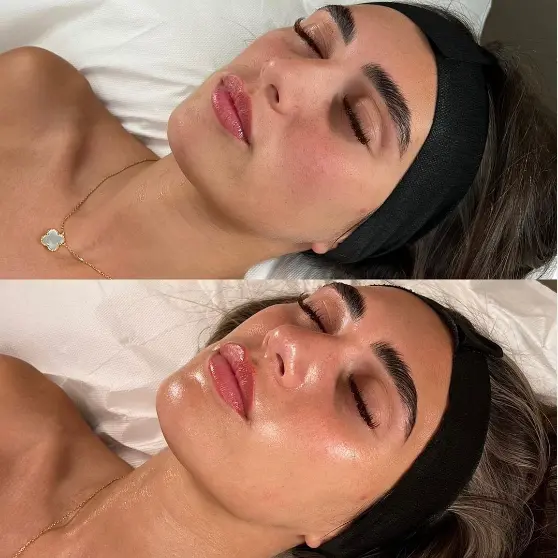 What is a HydraFacial - Get Clear, Youthful Skin Without Downtime 5 What Is a HydraFacial