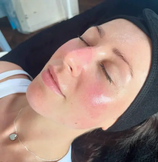 What is a HydraFacial - Get Clear, Youthful Skin Without Downtime 3 What is a HydraFacial