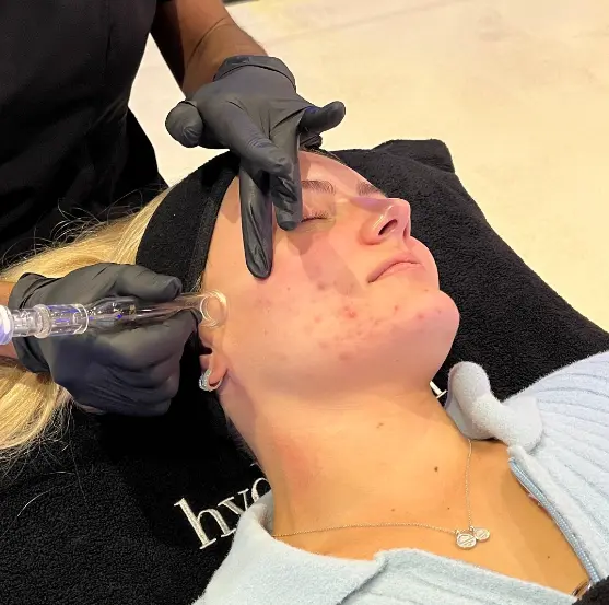 What is a HydraFacial - Get Clear, Youthful Skin Without Downtime 2 What is a HydraFacial