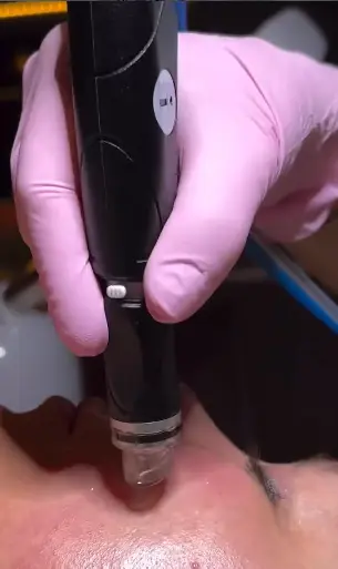What is a HydraFacial - Get Clear, Youthful Skin Without Downtime 6 What is a HydraFacial